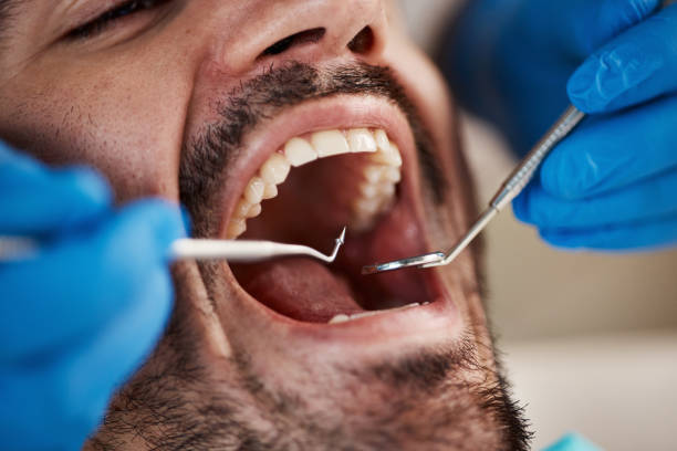 Best Knocked-Out Tooth (Avulsed Tooth) Treatment in Bloomingdale, GA