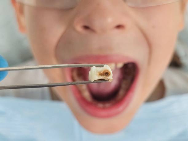 Best Emergency Root Canal Therapy in Bloomingdale, GA